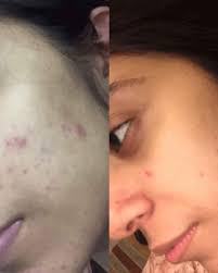 Skin Brightening Serum [ Glutathione 2% Alpha Arbutin 2% Kojic Acid 2% Niacinamide 5% ]